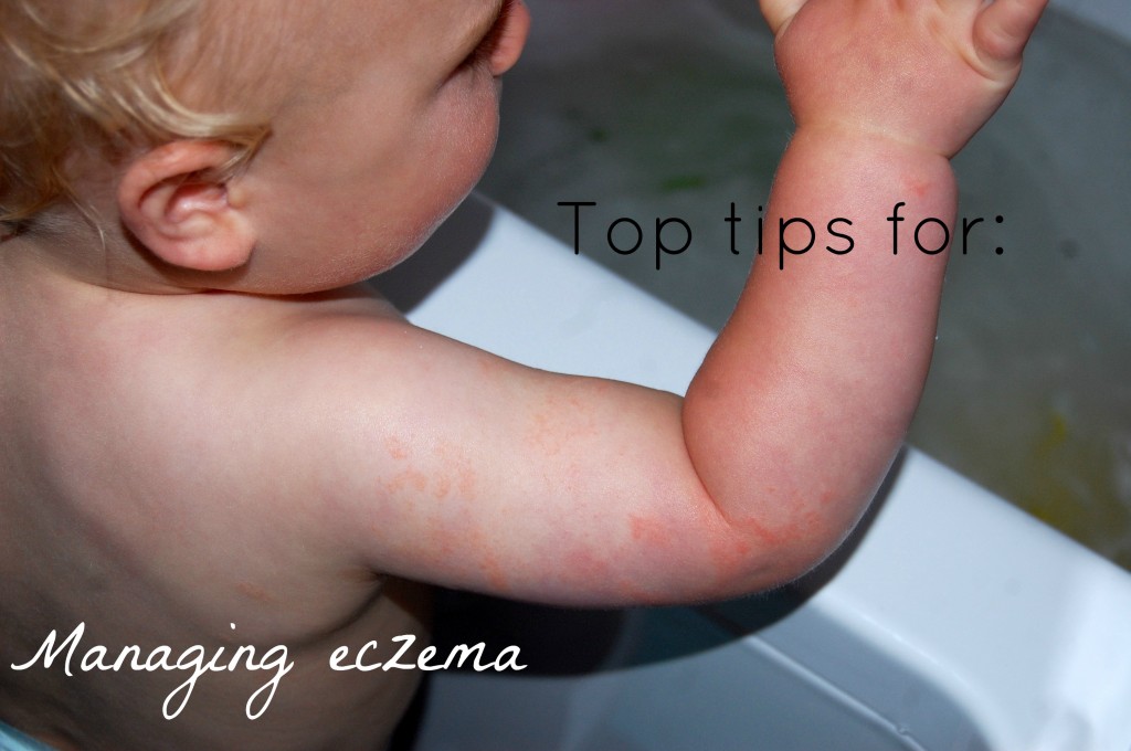 tips for managing eczema